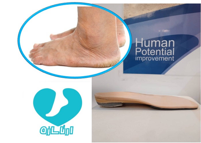 کفی سفارشی پای افراد مبتلا به دیابت