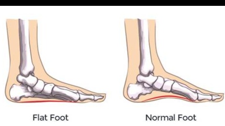 Knowledge of foot biomechanics and insole