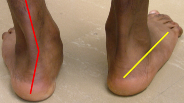 Pes Valgus