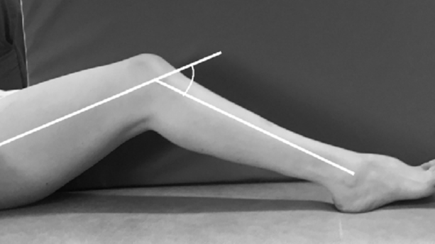 Knee Flexion Contracture